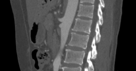 Vertebral pneumatocyst | Image | Radiopaedia.org