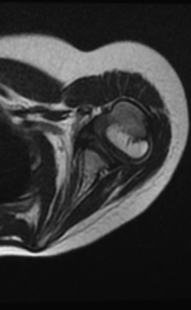 Glenohumeral Dysplasia 