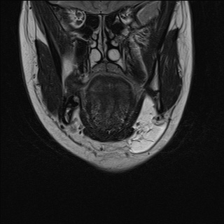 Submandibular lymphatic malformation | Image | Radiopaedia.org