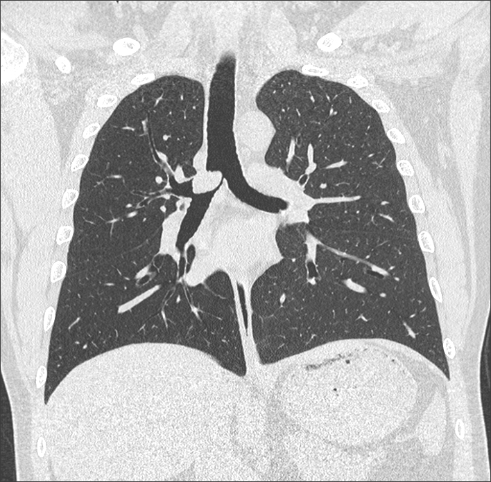 Bronchial carcinoid tumor | Image | Radiopaedia.org