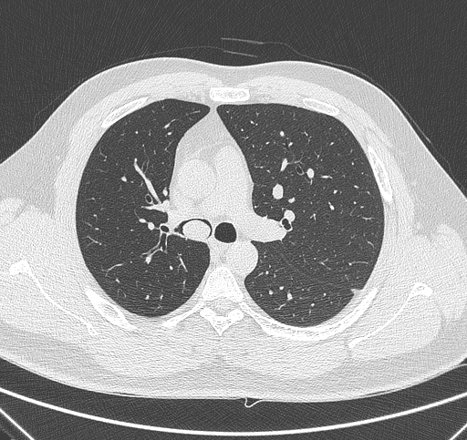 Bronchial carcinoid tumor | Image | Radiopaedia.org