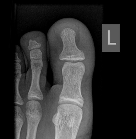 fracture distal phalanx great toe icd 10