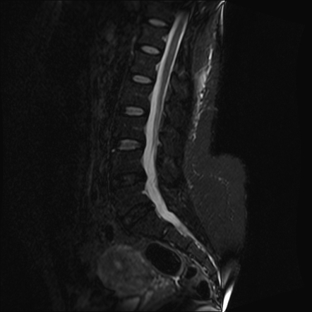 Annular fissure | Image | Radiopaedia.org