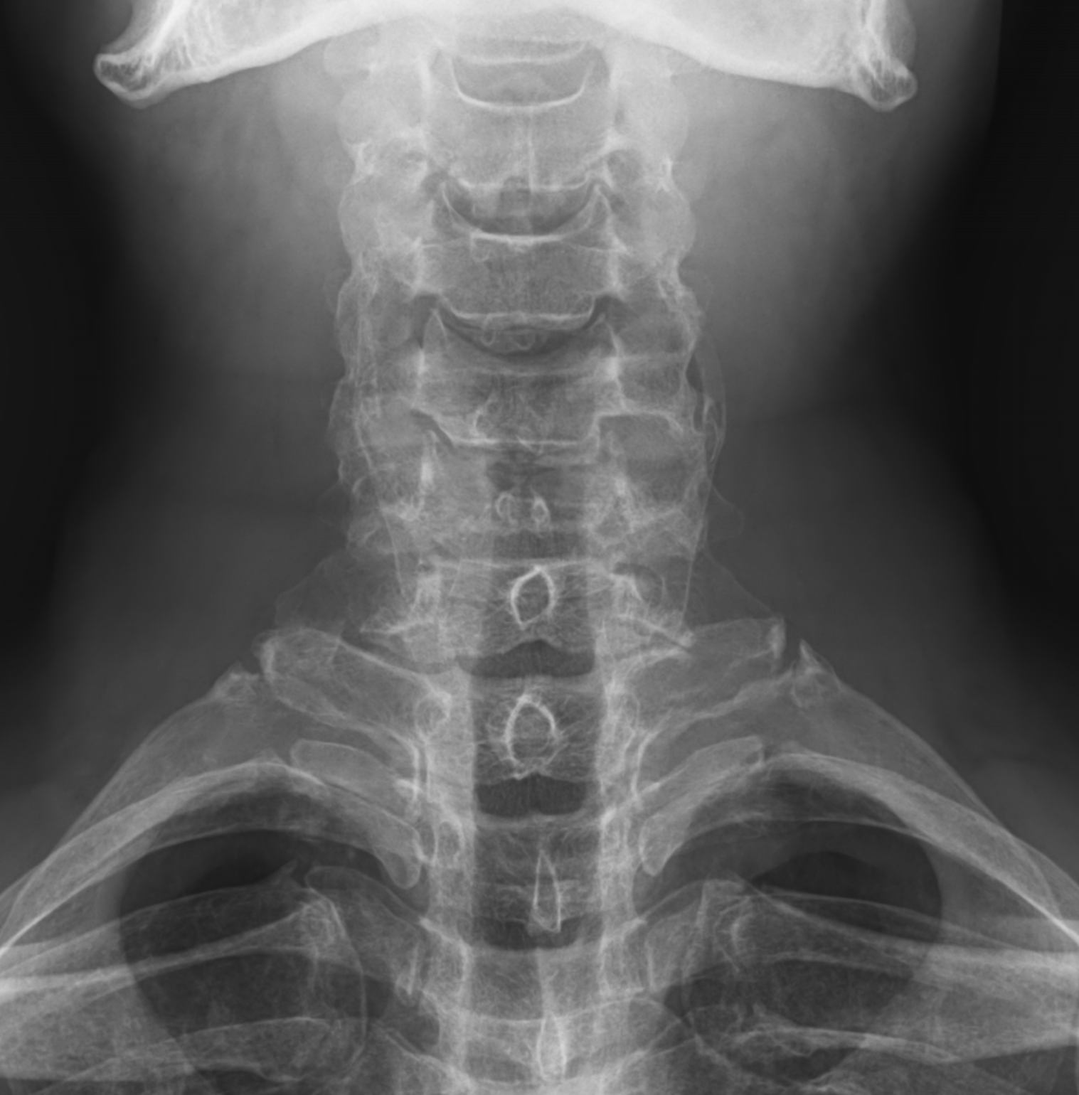 Cervical intercalary bone | Image | Radiopaedia.org