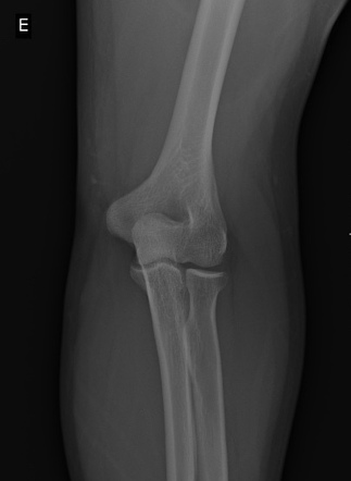 Forearm fracture | Image | Radiopaedia.org