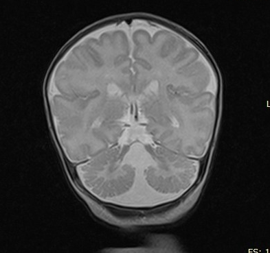 Joubert syndrome | Image | Radiopaedia.org