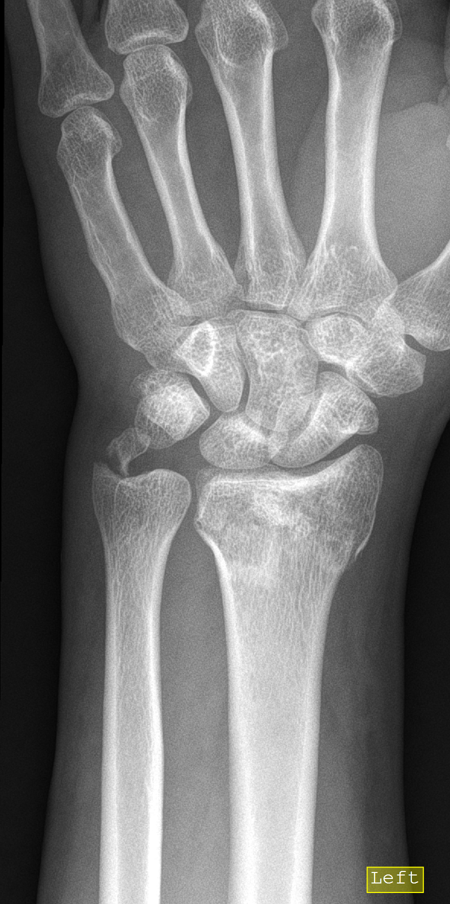 Distal Radial And Ulnar Styloid Fractures Image