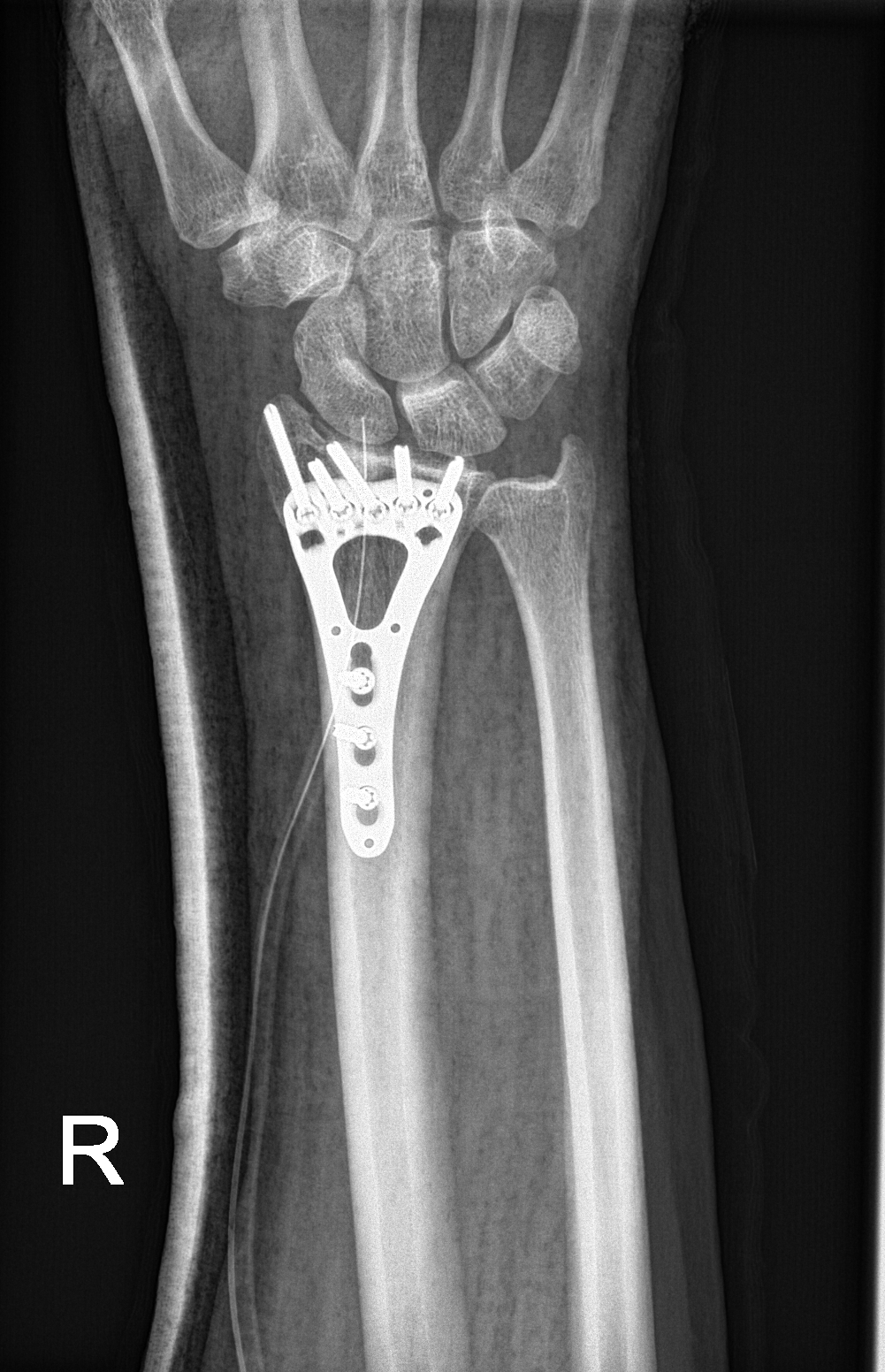 Die-punch fracture | Image | Radiopaedia.org