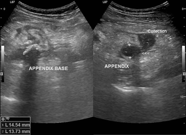 Featured image of post Radiopaedia Appendicitis It may be acute or chronic