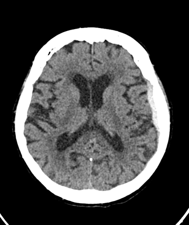 Acute Traumatic Subdural Haematoma Radiology Case Radiopaedia Org