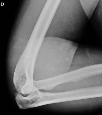 Pilon Fracture And Elbow Dislocation | Image | Radiopaedia.org