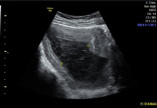 Subchorionic hemorrhage | Image | Radiopaedia.org