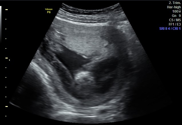 Subchorionic hemorrhage | Image | Radiopaedia.org