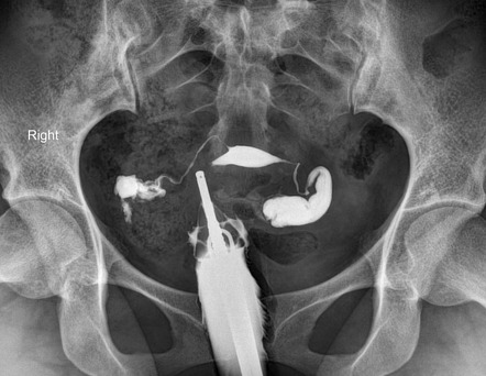 Bilateral hydrosalpinx | Image | Radiopaedia.org