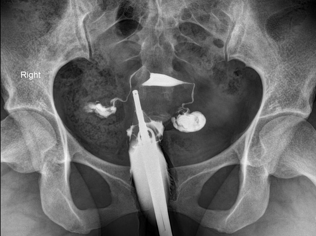 Bilateral hydrosalpinx | Image | Radiopaedia.org