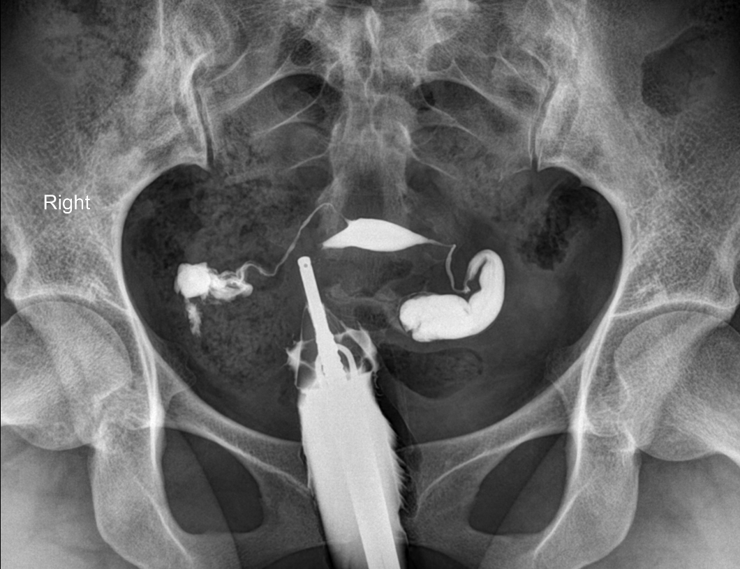 Bilateral hydrosalpinx | Image | Radiopaedia.org