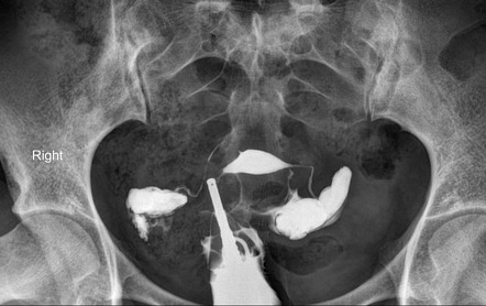 Bilateral hydrosalpinx | Image | Radiopaedia.org