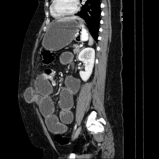 Afferent loop syndrome - secondary to incarcerated trocar site hernia ...