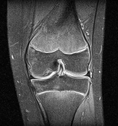 Osteochondritis dissecans of the knee - paediatric | Radiology Case ...