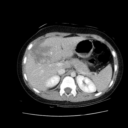 Hepatic Injury 