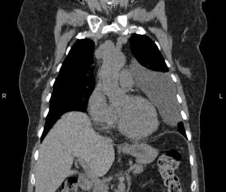 Giant pericardial cyst | Image | Radiopaedia.org