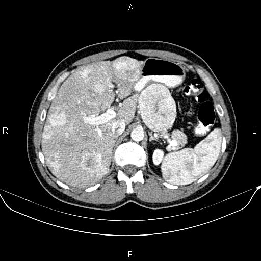 Pancreatic Neuroendocrine Tumor | Image | Radiopaedia.org