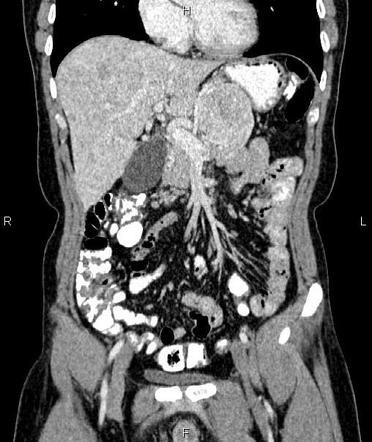 Pancreatic Neuroendocrine Tumor Image Radiopaedia Org