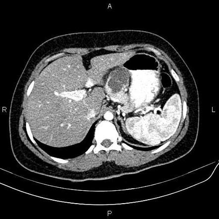 Pancreatic serous cystadenoma | Radiology Case | Radiopaedia.org