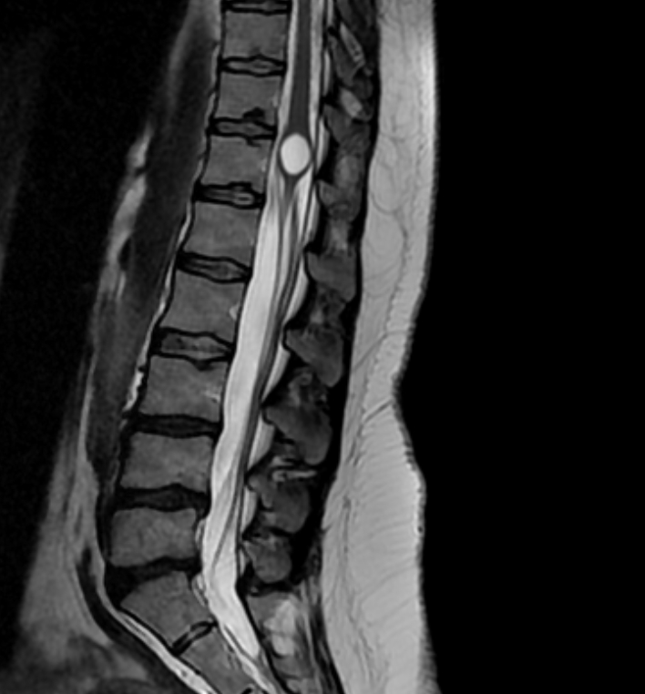 Cyst Of The Conus Medullaris Image