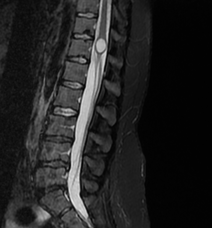 Cyst Of The Conus Medullaris Image