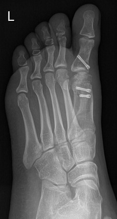 Hallux valgus correction surgery | Image | Radiopaedia.org