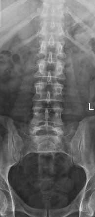 Spondylolisthesis | Radiology Case | Radiopaedia.org