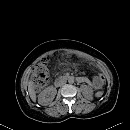 Gallbladder perforation | Radiology Reference Article | Radiopaedia.org