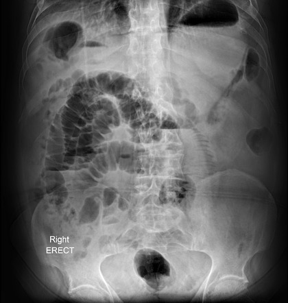 Small bowel obstruction | Radiology Case | Radiopaedia.org