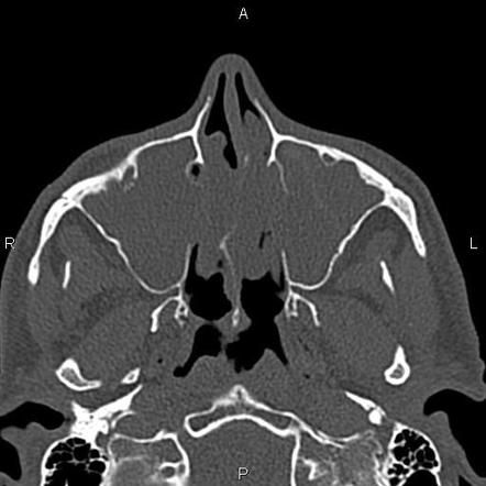 Image | Radiopaedia.org