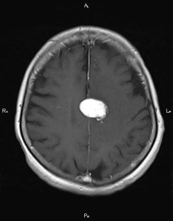 Falx Meningioma 