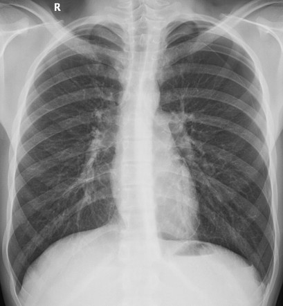 Pneumothorax | Radiology Case | Radiopaedia.org