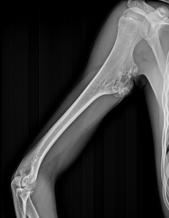 Osteochondroma - humerus | Image | Radiopaedia.org