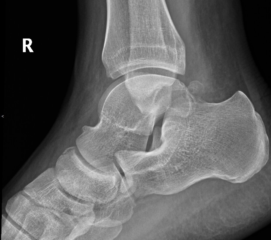 Dorsal Avulsion Fracture Of The Navicular Bone Image 0259