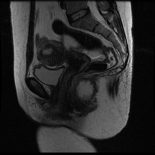 Horseshoe intersphincteric abscess with fistula | Image | Radiopaedia.org