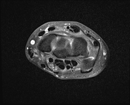 Bifid median nerve and persistant median artery | Radiology Case ...