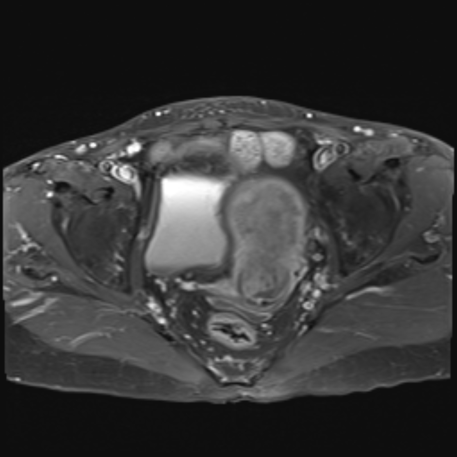 Endometrial adenocarcinoma | Image | Radiopaedia.org