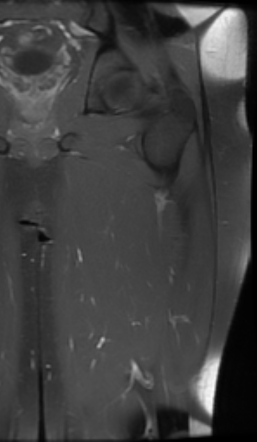 Intramuscular Hemangioma - Gluteus Maximus Muscle 