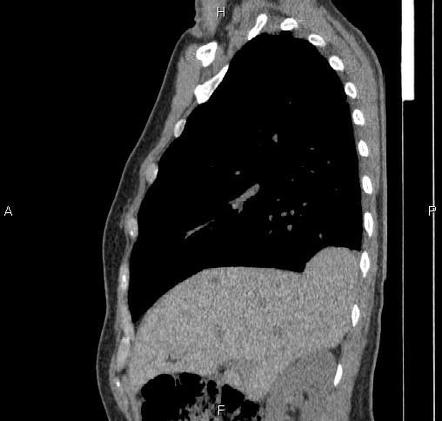 Focal diaphragmatic eventration | Image | Radiopaedia.org