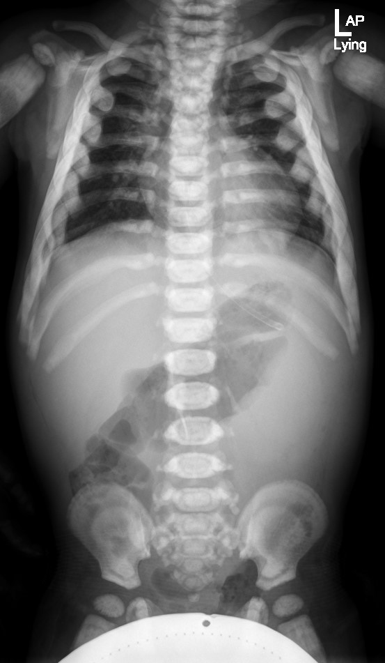 Osteopetrosis | Image | Radiopaedia.org