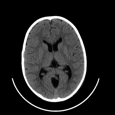 Playlist 'CNS 28 - Posterior Fossa Cystic Lesions' by Dr. Praveen ...