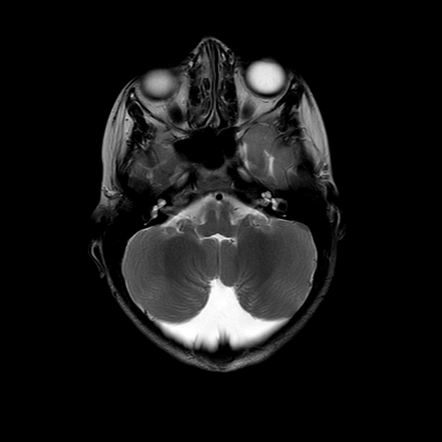 Mega cisterna magna | Radiology Reference Article | Radiopaedia.org