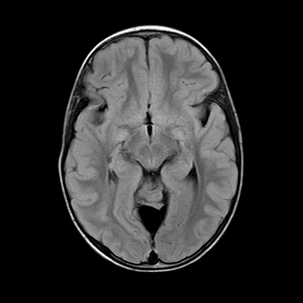 Atretic occipital cephalocele | Image | Radiopaedia.org