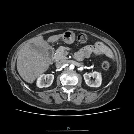 Fibromuscular dysplasia | Radiology Reference Article | Radiopaedia.org