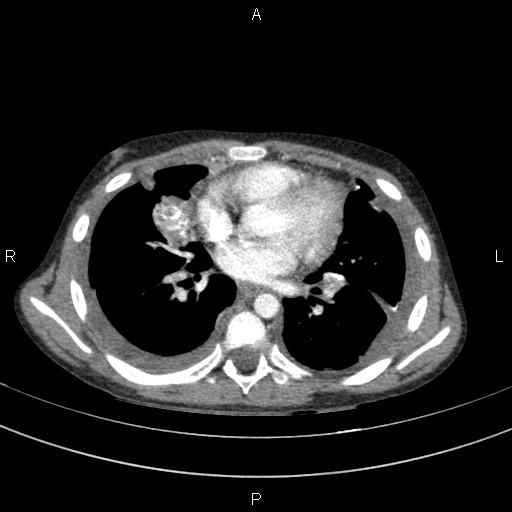 Lung metastases from osteosarcoma | Image | Radiopaedia.org